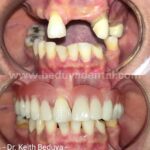 Removable Denture
