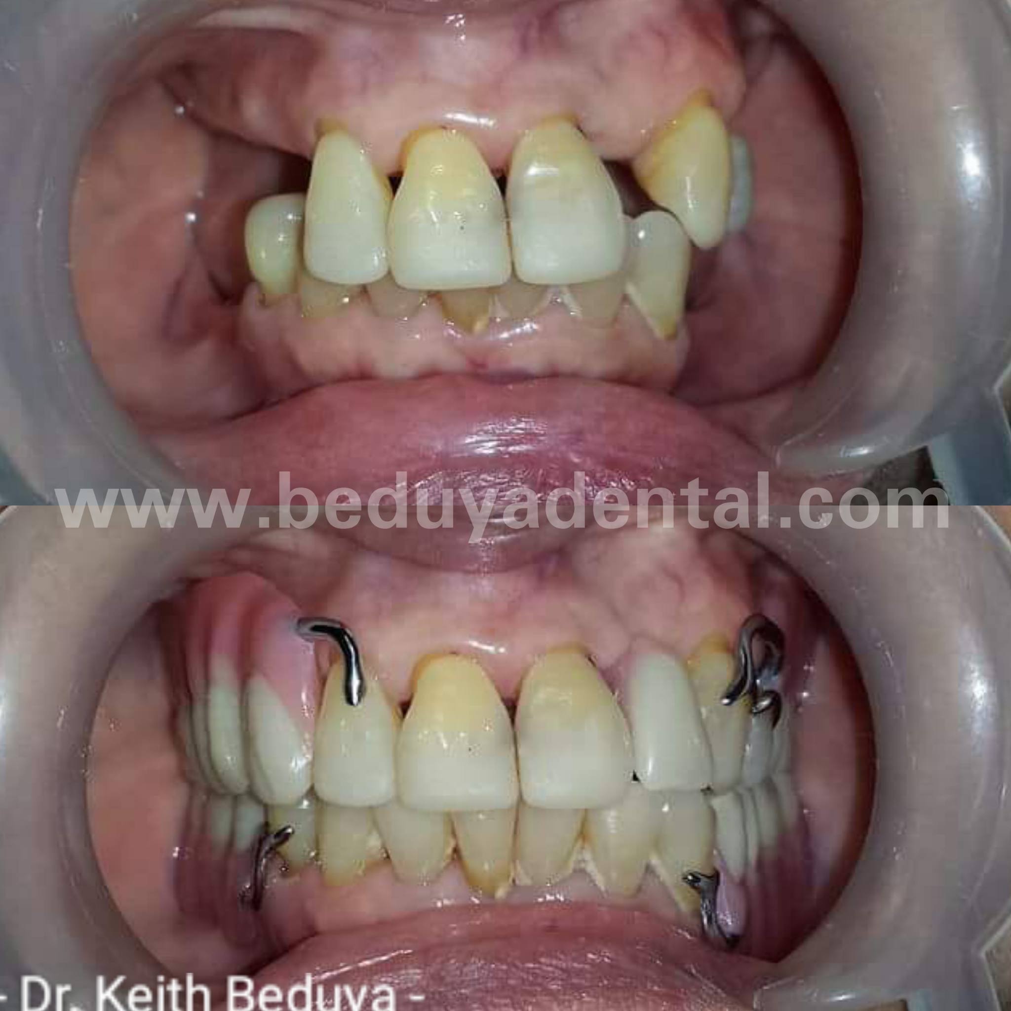 Removable Denture