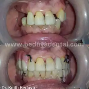 Removable Denture - Before & After photos