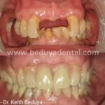 Removable Denture