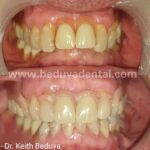 Removable Denture