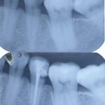 Root Canal Therapy