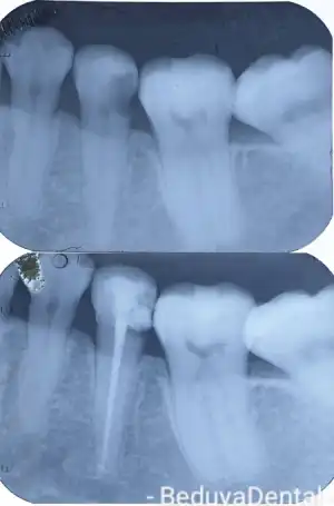 Root Canal Therapy - Before & After photos