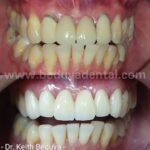 Zirconia Bridge