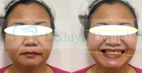A. At rest, the left corner of the lip was positioned lower than the right, resulting in facial asymmetry. B. During smiling, the left side of the dentition was positioned lower than the right, resulting in an occlusal cant. Ideally, the two yellow reference lines should be parallel.