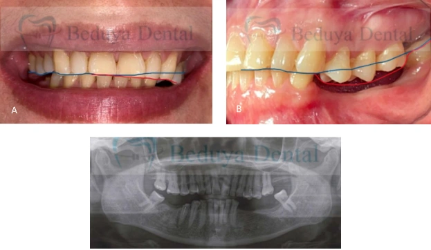 A. Front. The blue line represents the normal level of the teeth, while the red line indicates the downward displacement of the affected teeth. B. Side. The affected side experienced significant space loss, making denture replacement more challenging. C. Panoramic radiograph. The crown of the lower right second premolar was fractured, with an under obturated root canal. The remaining lower molars leaned forward.