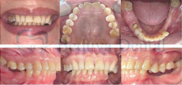Intraoral photographs showing the patient's dentition with multiple dental problems, collectively contributing to dentoalveolar collapse.